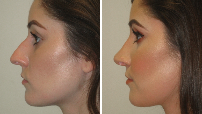 rhinoplasty expert nyc